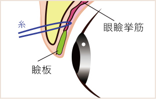 瞼板に触れず挙筋と皮膚を糸で繋ぐ